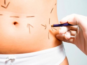 Tummy Tuck