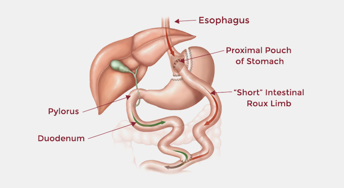 gastric bypass