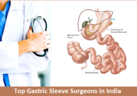 Gastric Sleeve Surgeons in India