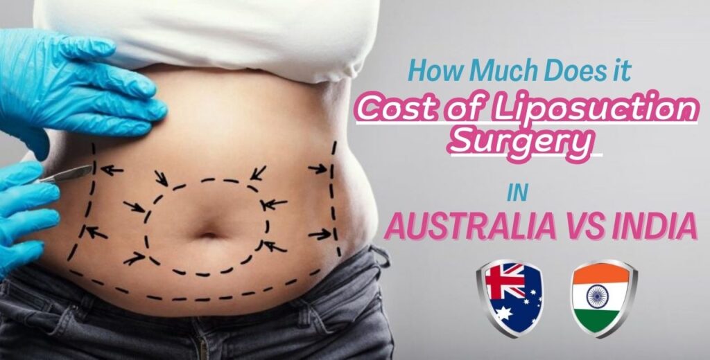 How Much Does it cost of Liposuction Surgery in Australia vs India
