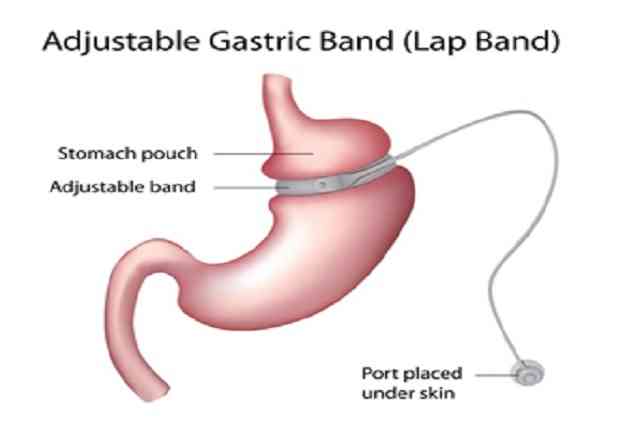 Laparoscopic নিয়মিত গ্যাস্ট্রিক ব্যান্ডিং