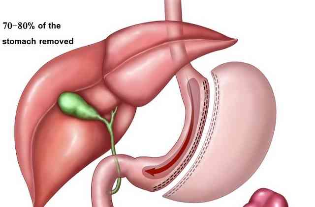 Dérivation gastrique laparoscopique