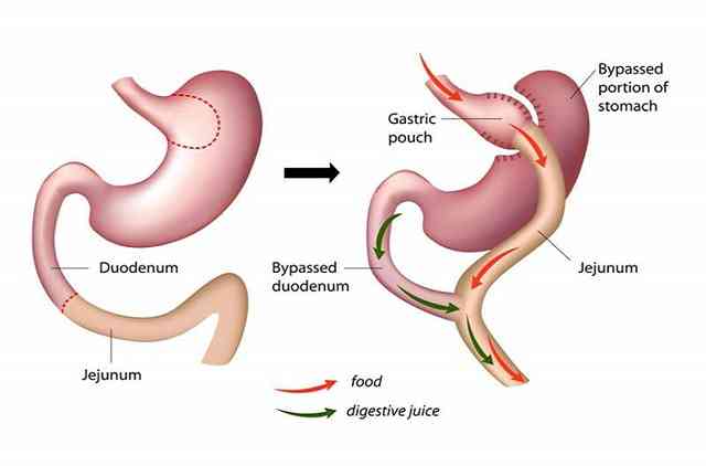 Dérivation gastrique mini laparoscopique