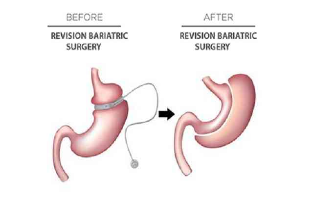 সংশোধন Bariatric পদ্ধতি