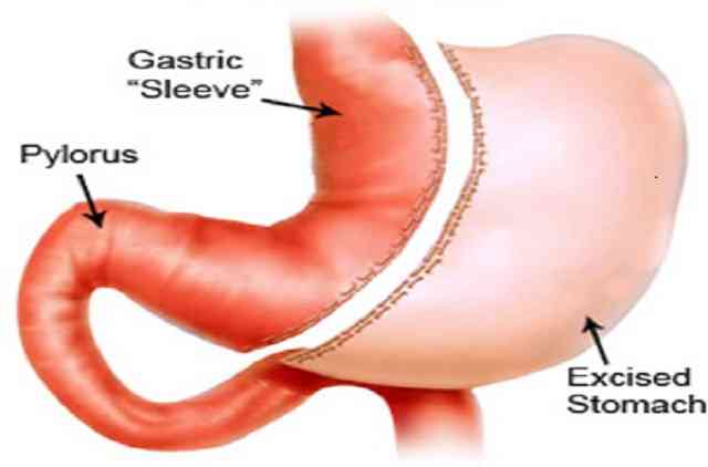 Gastrectomie manchon laparoscopique