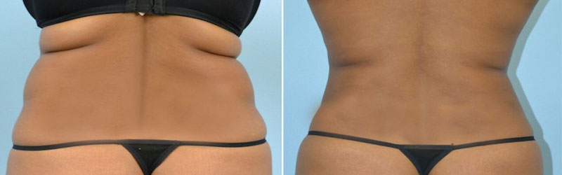 Body Contouring in India