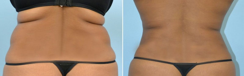 Liposculpture in India