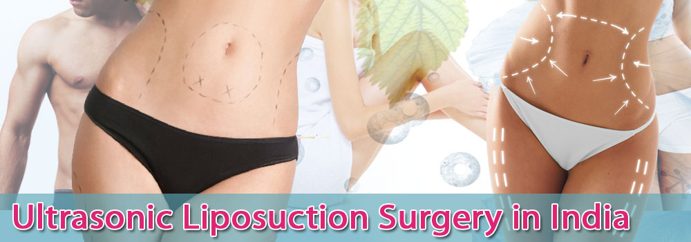 Ultrasonic Liposuction Surgery in India