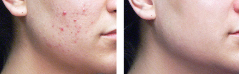 Acne Treatment Before and After