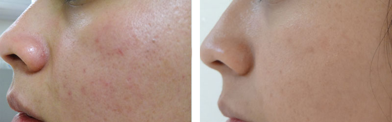 Acne Treatment Before and After