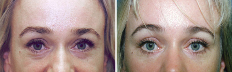 Brow Lift Before and After