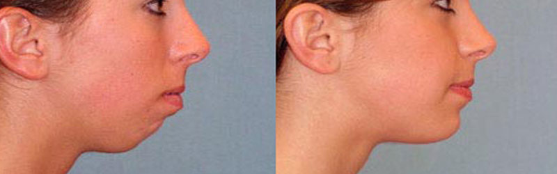 Chin Cheek Before and After