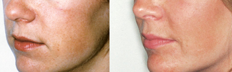 Chin Cheek Before and After