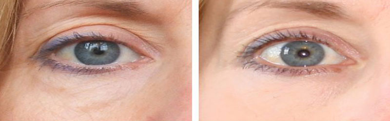 Dark Circles Before and After2