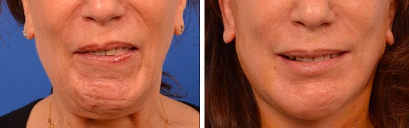 Facial Paralysis Before and After