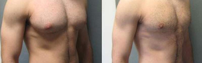 Gynecomastia Before and After