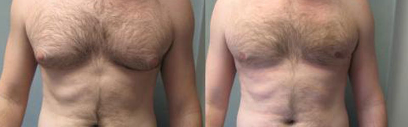 Gynecomastia Before and After