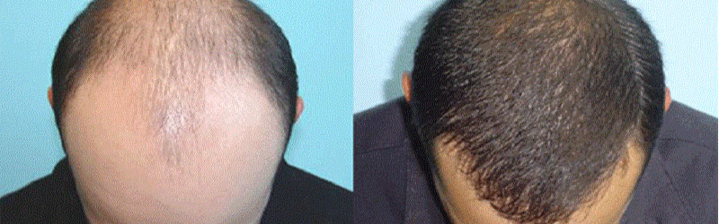 Hair Transplant in India