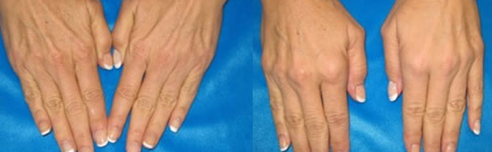 Hand Rejuvenation Before and After