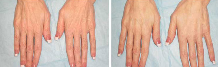 Hand Rejuvenation Before and After