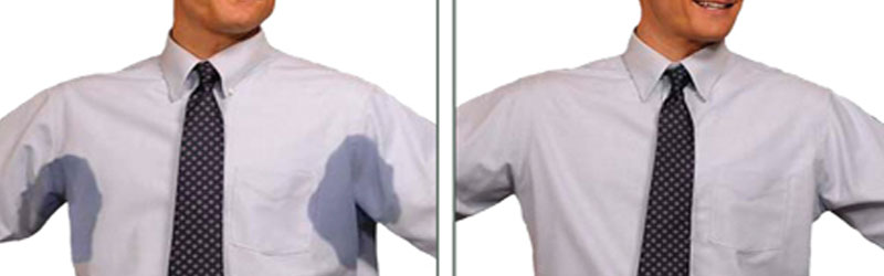 Hyperhidrosis Before and After