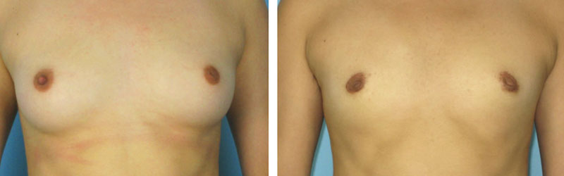 Key Hole Breast Reduction