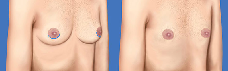 Key Hole Breast Reduction