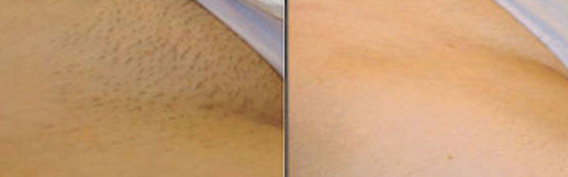 Laser Hair Treatment Before and After