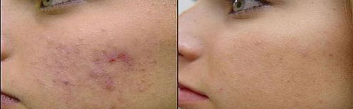 Scar Removal Before and After