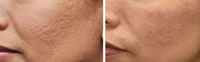 Scar Removal Before and After2