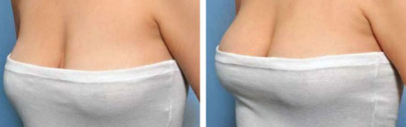 Scarless Breast Augmentation Before and After