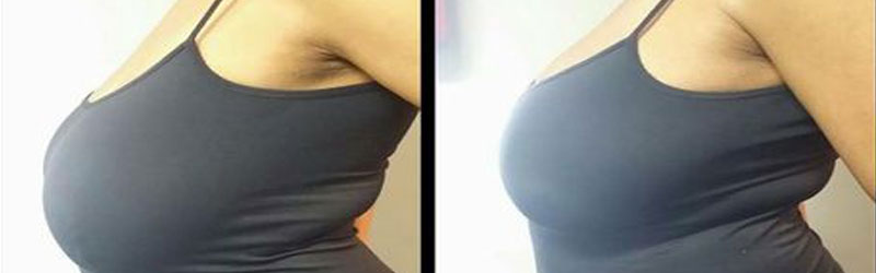 Scarless Breast Augmentation Before and After