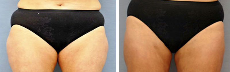 Thigh Lift Before and After