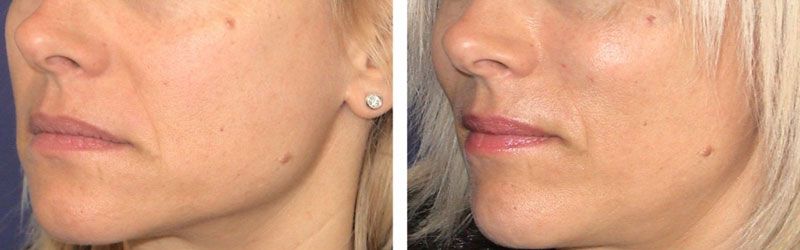 Thread Lift Before and After