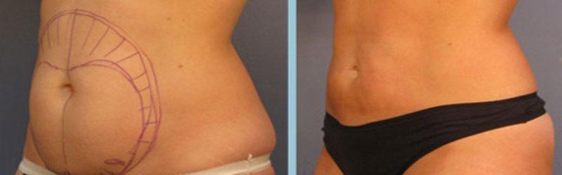 Vaser Liposuction Before and After