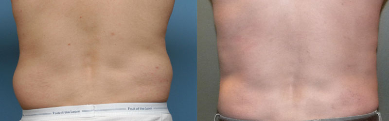 Vaser Liposuction Before and After