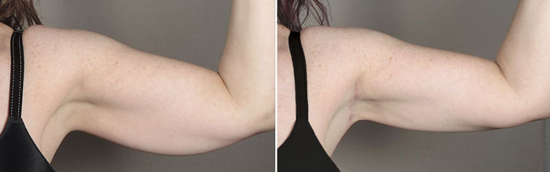 Arm Lift Before and After