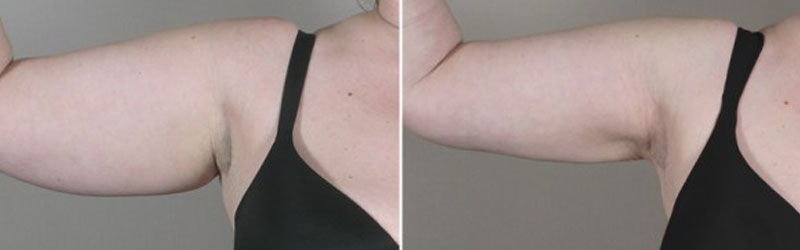 Arm Lift Before and After