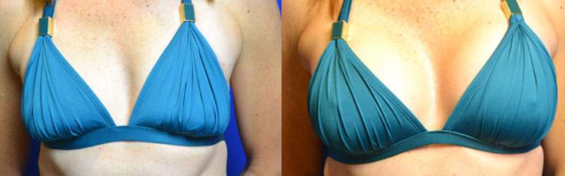 breast augmentation