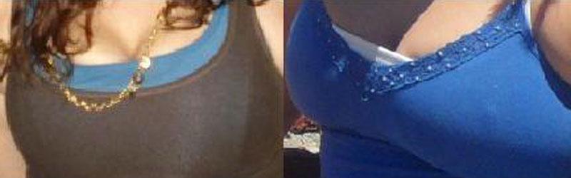 breast reduction