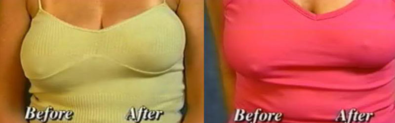 breast uplift