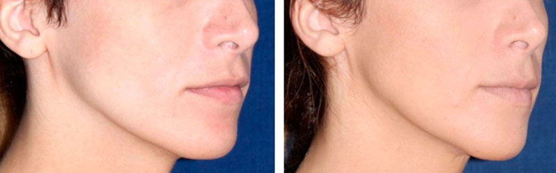 chin reduction