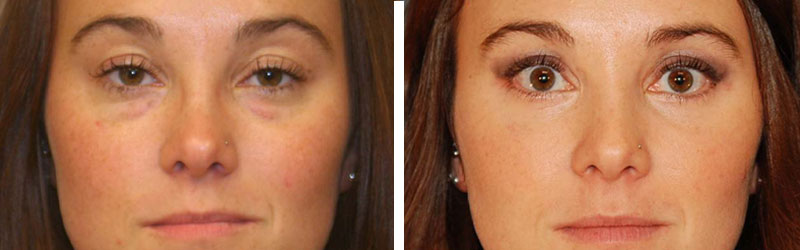 eyelid surgery