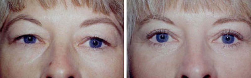 eyelid surgery