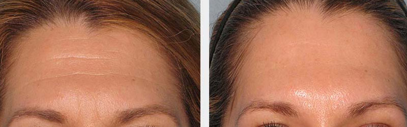 forehead lift