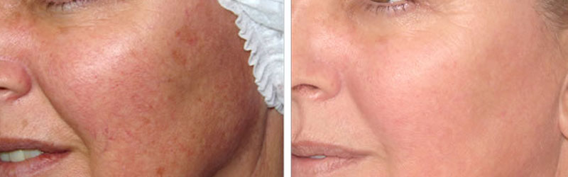 intense pulsed light treatment