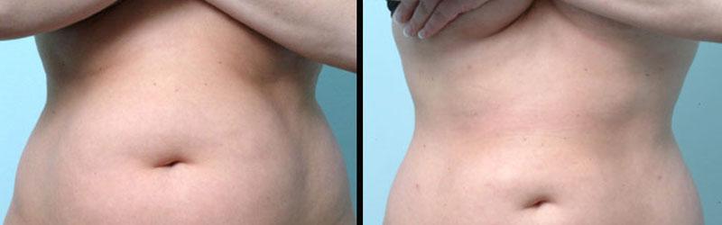 liposuction in india