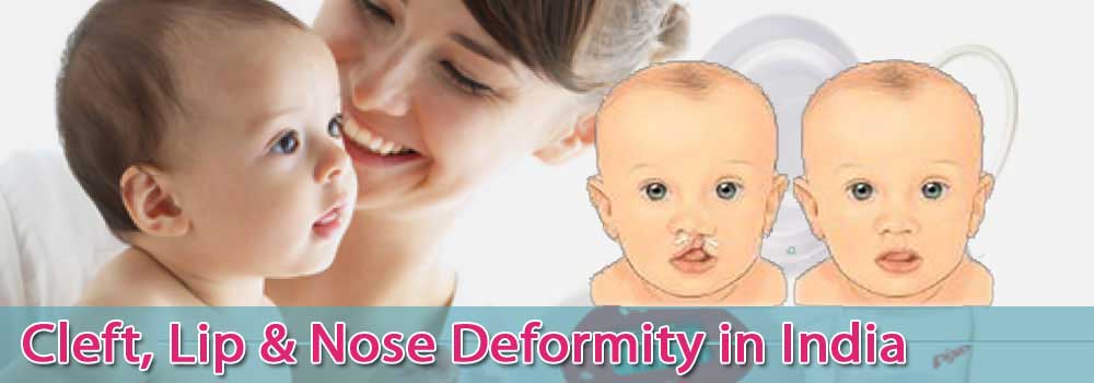 Low Cost Cleft Lip Nose Deformity In India