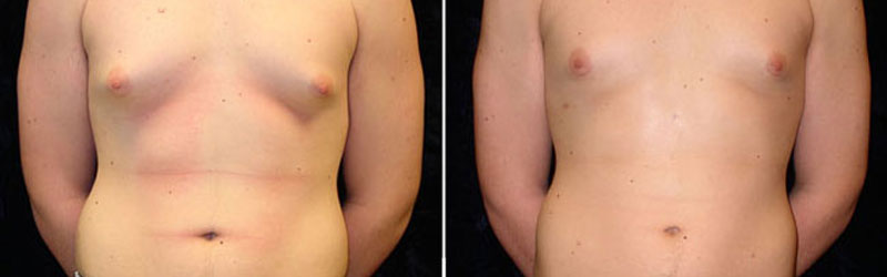 Male Breast Reduction in India