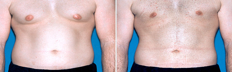 Male Breast Reduction in India